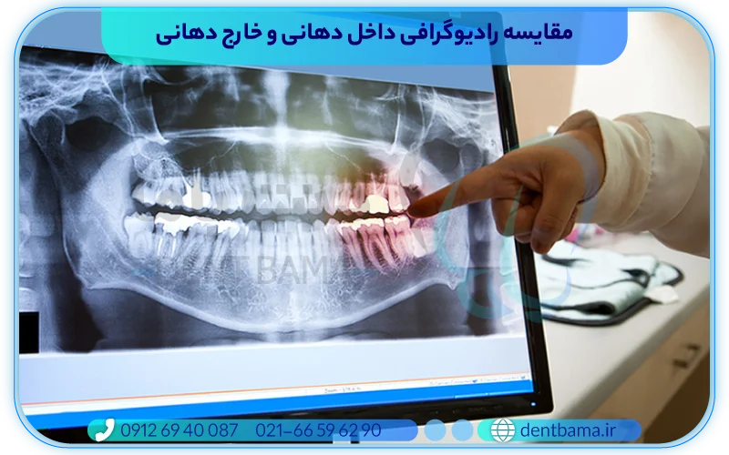 مقایسه رادیوگرافی خارج دهانی و داخل دهانی