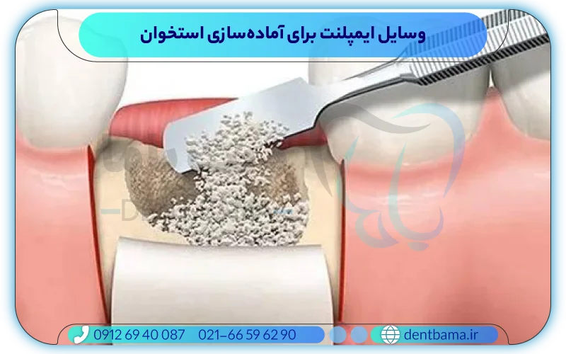 وسایل ایمپلنت برای آماده‌سازی استخوان